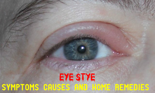 what causes stye on eye