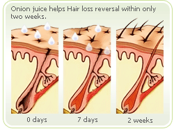 onion-juice-hair-loss-2 weeks