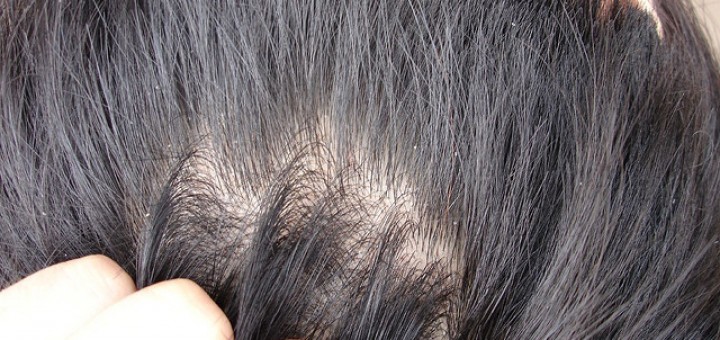 dandruff simple easy tips