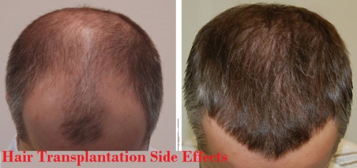 Hair Transplantation side effects