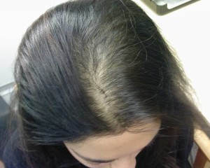 Frontal Hair Loss Treatment