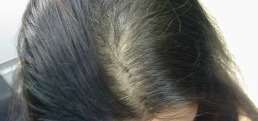 Frontal Hair Loss Treatment