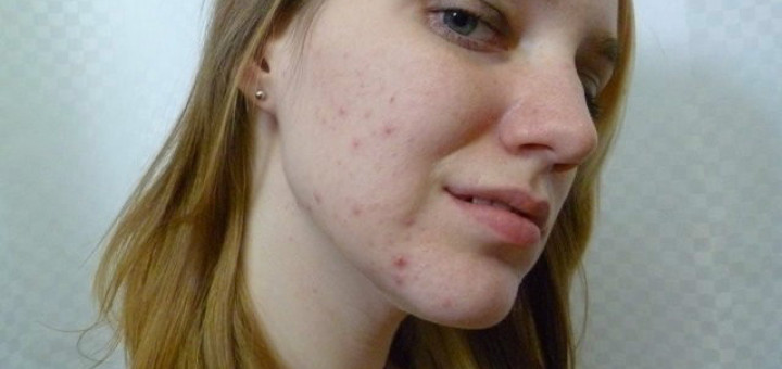Teenage Acne Cure Prevent