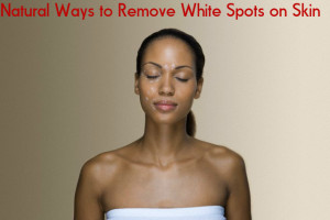 White Spots on Skin Remedies