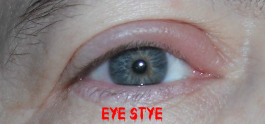 Eye Stye Symptoms Causes Remedies