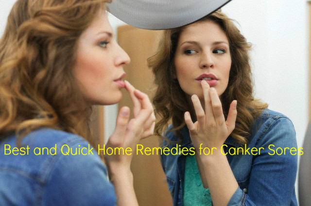 Canker Sores Home Remedies