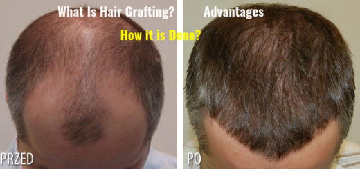 Hair Grafting Method Advantages