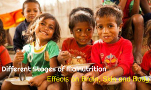 Malnutrition Stages Effects Body