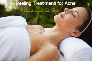 Peeling Treatment for Acne