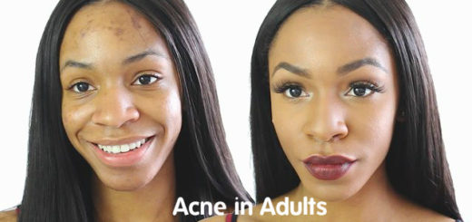 Adult Acne Cure Tips