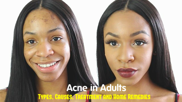Adult Acne Cure Tips
