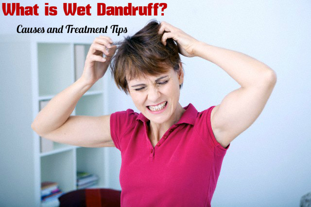 Wet Dandruff Causes Treatment