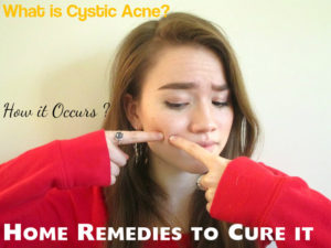 Cystic Acne Causes Home Remedies