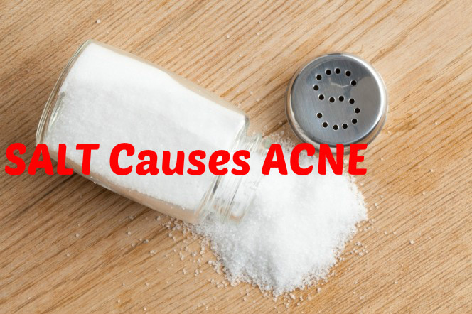Salt can Cause Acne