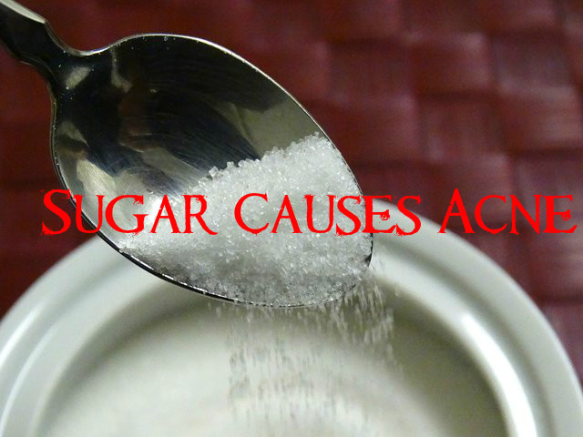 Sugar can Cause Acne