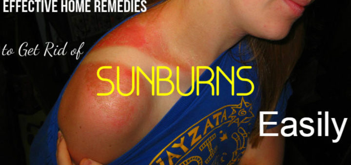 Sunburns Effective Home Remedies