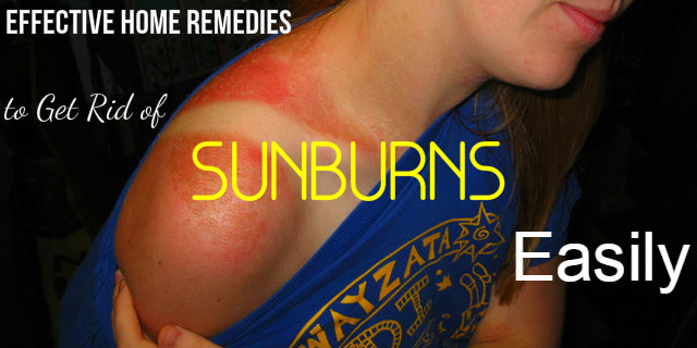 Sunburns Effective Home Remedies