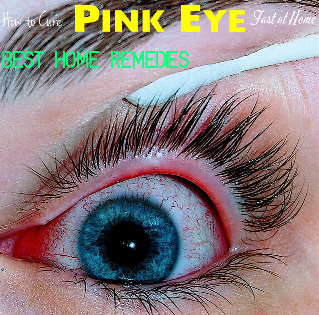 Pink Eye Home Remedies