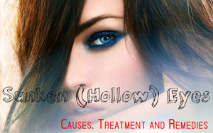 Sunken Eyes Causes Treatment Remedies
