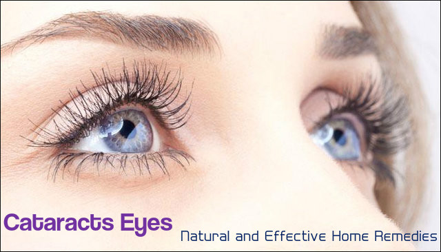 Cataracts Eyes - Home Remedies