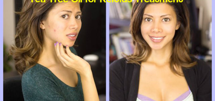 Tea Tree Oil for Keloids