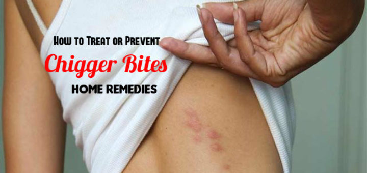 Chigger Bites Home Remedies