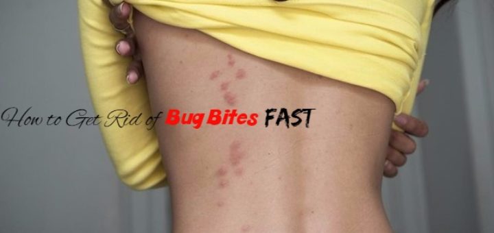 Bug Bites Home Remedies