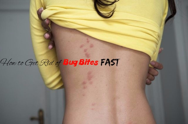 Bug Bites Home Remedies