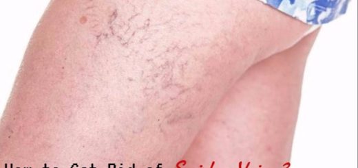 Spider Veins Home Remedies