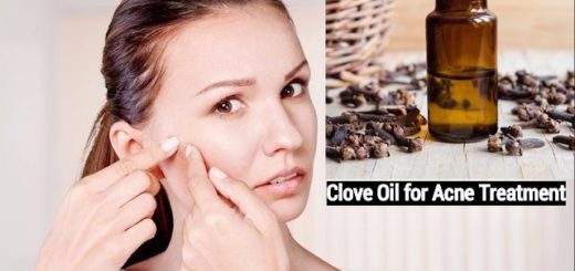 Clove Oil for Acne