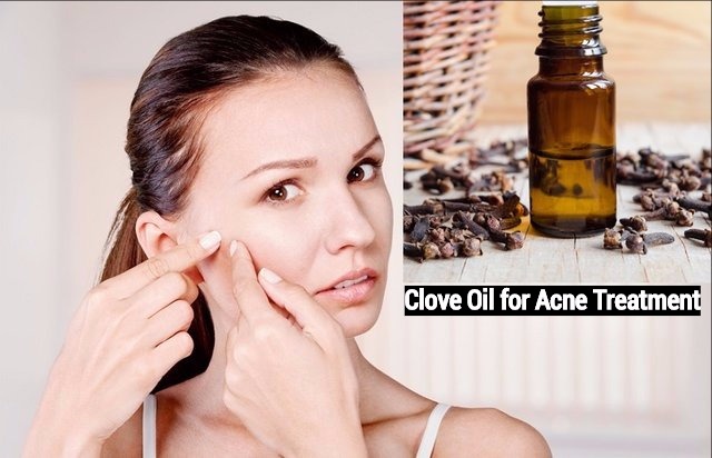 Clove Oil for Acne