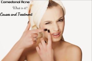 Comedonal Acne Causes Treatment