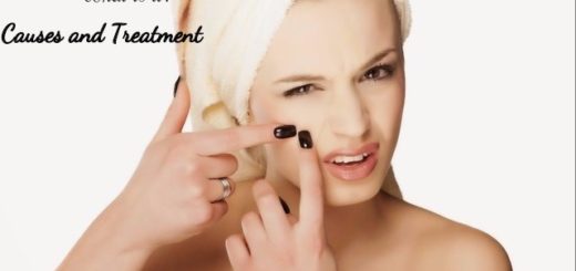 Comedonal Acne Causes Treatment