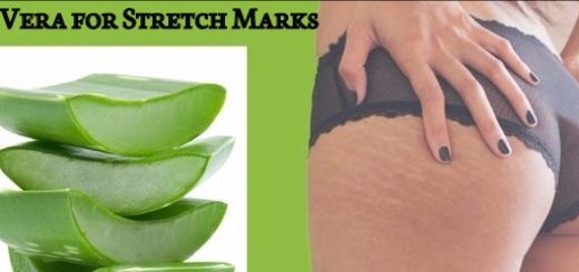 Aloe Vera for Stretch Marks